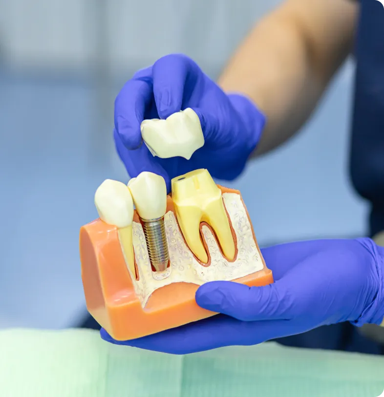 Dental Crown Types